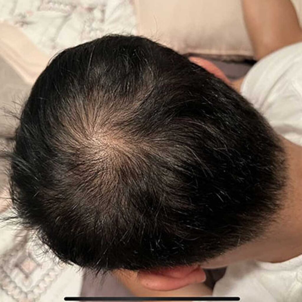 Before-Male